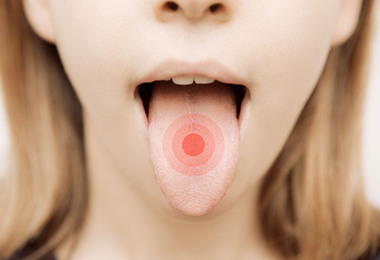 TONGUE BURNING SOOTHE WITH NATURAL REMEDIES